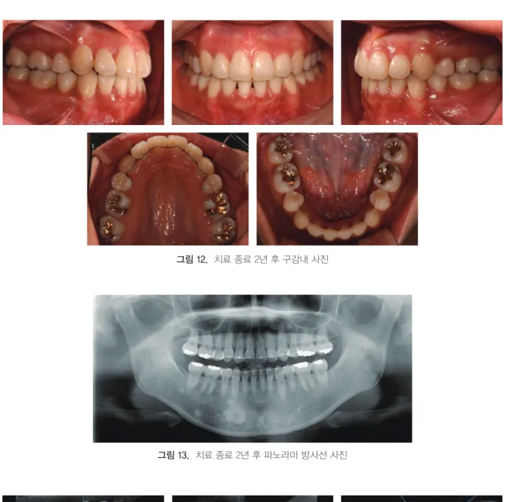 그림 14.  치료 종료 2년 후 CBCT 방사선 사진. (A) Sagittal View. (B) Coronal View. (C) Axial View.