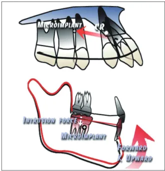 그림 3.  Micro-implant를 이용한 Directional force 개념의 적용