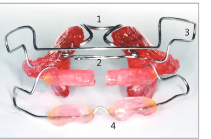 그림  1.    Elastic  open  activator.  Coffin  spring(1),  lingual  guiding wire(2), labial wire(3), lip pad(4)로 구성되어 있다.