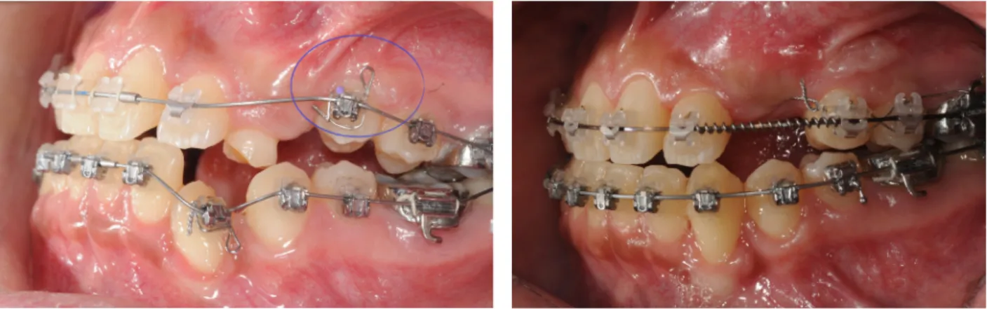 그림 11.  #24 free gingival graft 전과 후의 구강 내 사진. 