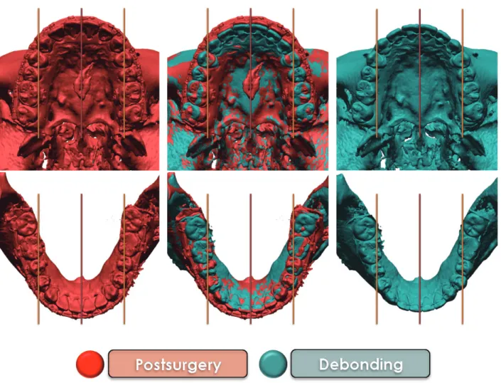 그림 14.  수술 후 1개월과 치료 종료 시 CBCT-based 모델 중첩. 
