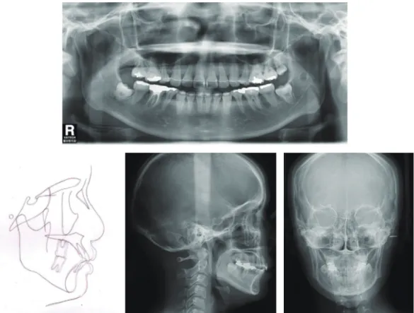 Fig 19.  치료 후 방사선 사진 및 중첩사진. 중첩사진에서 볼수 있듯이 상하악 전치부의 치축개선이 잘 이루어 졌다.