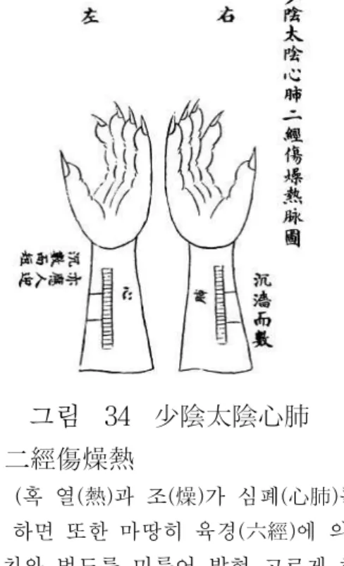 그림 34 少陰太陰心肺 二經傷燥熱 (혹 열(熱)과 조(燥)가 심폐(心肺)를 상하 게 하면 또한 마땅히 육경(六經)에 의거하여 이치와 법도를 미루어 밝혀 고르게 하고 다 스린다.) 人迎脈에서도 氣口脈과 마찬가지로 그림 을 그려서 脈象의 종류와 위치를 나타내고 있다