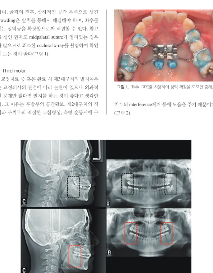 그림 1.  TMA-RPE를 사용하여 상악 확장을 도모한 증례.하며, 골격의 전후, 상하적인 공간 부족으로 생긴 crowding은 발치를 통해서 해결해야 하며, 좌우문제는 상악궁을 확장함으로써 해결할 수 있다