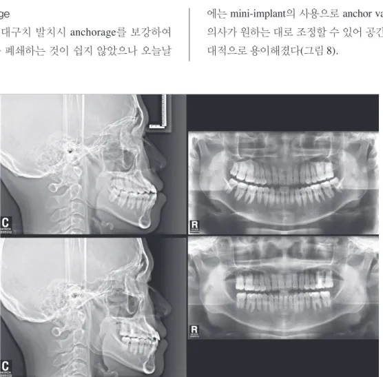 그림 8.  #18, 37, 47을 발치하고 치료한 증례.