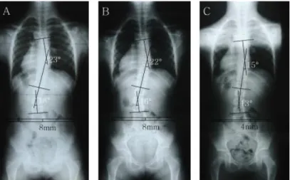 Fig.  6.  Change  of  radiograph  at  before  and  after  treatment  (Case  3).