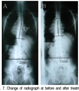 Fig.  7.  Change  of  radiograph  at  before  and  after  treatment  (Case  4). A  :  Before  treatment  (2012.02.15) B  :  After  treatment  (2012.04.21) Cobb`s  angle(degree) Difference  of  pelvic  height(mm) Difference  of balance(%) 12.02.15 13 3 6.8 
