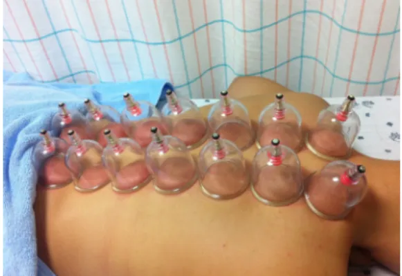 Fig.  2.  Dry  cupping  applied  to  back-shu  points(side  view). 2) 심박변이도 측정 (1)  측정 기기 심박변동 측정용 맥파계인 SA-3000P(Medicore  Co.,  Ltd.,  서울)을 이용하여 좌우 손목부위와 좌 측 발목부위에 각각 측정전극을 부착한 후 5분간  측정하였다