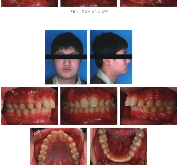 그림 7.  증례 1의 치료 종료 시 구외 및 구내 사진.