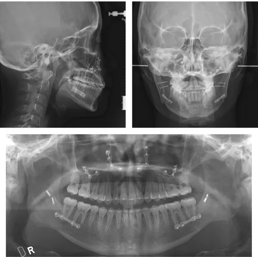 그림 15. 치료 종료 시 두부계측 방사선사진 및 파노라마 사진