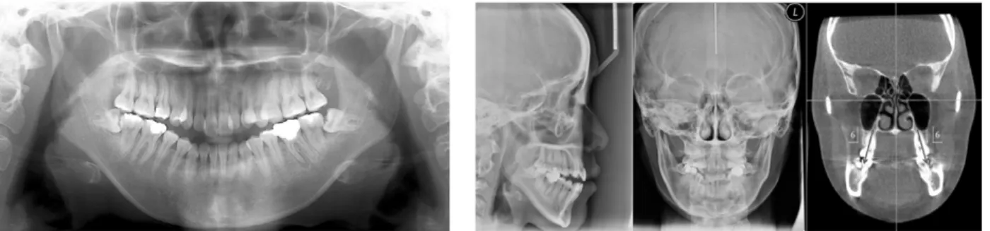 그림 3. 초진 시 파노라마 방사선 사진 및 두부 규격 계측 사진, CBCT 영상