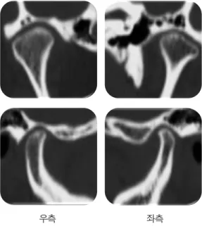 그림 4. TMJ MRI우측 좌측폐구개구 그림 5. TMJ CT우측 좌측환자는 임상적으로 CR-MI discrepancy를 보였으며,그 양은 수직적(overbite)으로 2.5  mm,  수평적(overjet)으로 3.0 mm였다.