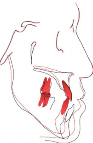 그림 22. 치료 전후 측모 두부계측방사선사진 중첩: 치료 전(검 정), 치료 후(빨강) 표 6. 치료 전후 측모 두부계측방사선사진 계측치lnitial FinalSNA (�)81.3184.56SNB (�)83.0982.14ANB (�)-1.782.42NSL-ML (�)39.7838.97U1 to SN (�)103.41109.02FH to OP (�)6.5413.79L1 to ML (�)79.1081.30Interincisor angle (�)131.711
