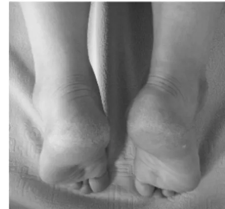 Fig.  1.  Leg  length  inequality.