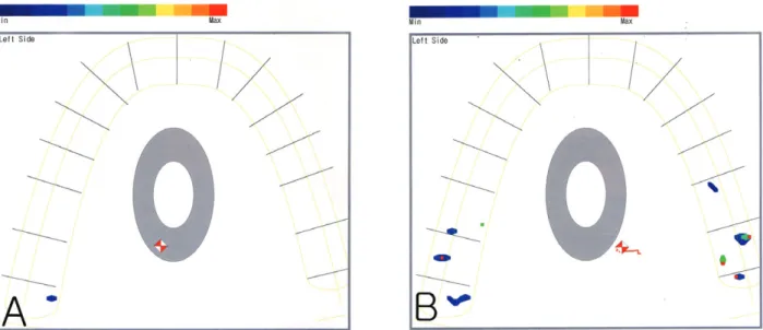그림 14.  2차 치료 종료후의 초기교합 (A) 및 최대감합 (B) 시 교합검사 (T-scan II system) 소견.