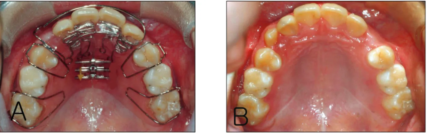 그림 7. Labial bow의 디자인을 변형시킨 midline correction type의 active plate (A) 및 상교정장치 사용 2.5개월 후 모습 (B).