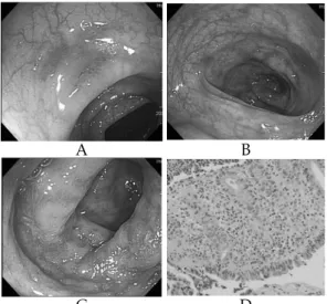 Fig.  1.  Colonoscopic  and  histologic  findings  of  the  patient.