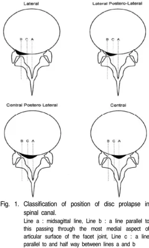 Fig.  1.  Classification  of  position  of  disc  prolapse  in  spinal  canal. 
