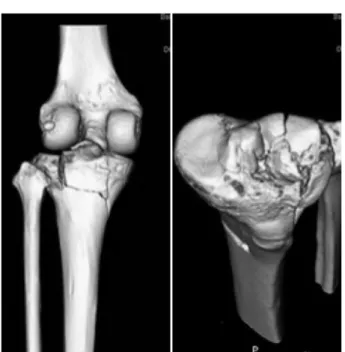 Fig.  1.  Knee  3D  CT,  communicated  fracture  of  proximal  tibia,  Schatzker  type  II.