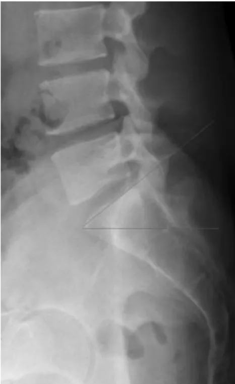 Fig.  1.  Lumbar  lordotic  angle. Fig.  2.  Ferguson’s  angle.Korea)를  사용하여  측정하였다.(3)  체질량지수(BMI)신장과  체중은  자동  신장계  BSM330  (Biospace,  Korea)에서  동일  측정자가  측정하였고,  체중(kg)을  신장2 (m2)으로  나누어  체질량지수(kg/m2)를  계산하였다.