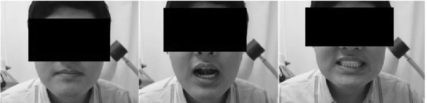 Fig.  2.  Picture  of  patient  on  April  10th.