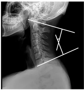 Fig.  1.  Measurement  of  the  craniovertebral  angle. Fig.  2.  Measurement  of  the  cervical  angle.