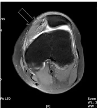 Fig.  1.  Left  knee  axial  MRI  (2013-04-01).