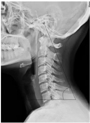 Fig.  1.  CV  Angle  be  measured  by  X-ray.자세로  유발되는  전방머리자세는  목에  생체역학적인  스트레스를  가하는  것으로  알려지며5),  목통증이  있는  사람은  나이가  비슷한  대조군에  비해  빈번하게  전방머리자세를  나타내는  것으로  보고되었다6).최근,  강  등7)의  연구에서는  전방머리자세가  자세  조절의  변화와  관련이  있을  수  있다는  결과를  제시하였으며, Anabela  등