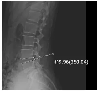 Fig.  1.  Measurement  of  lumbar  lordotic  angle.