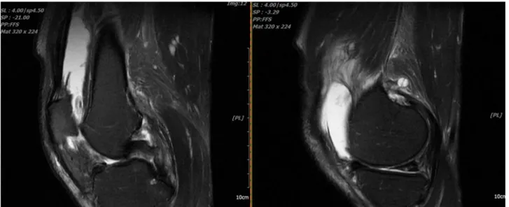 Fig.  5.  Magnetic  resonance  imaging  of  left  knee  -  sagittal  view  (April  10,  2020).