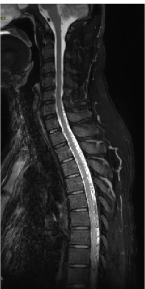 Fig.  3.  Spinal  arteriography  image  of  the  patient.