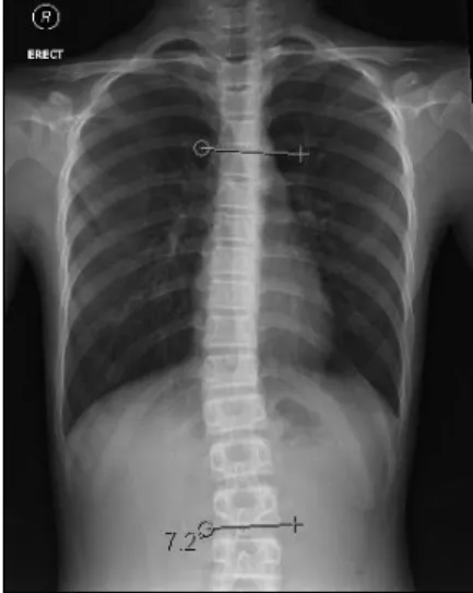 Fig.  5.  T-spine  AP  (2014.  6.  7).