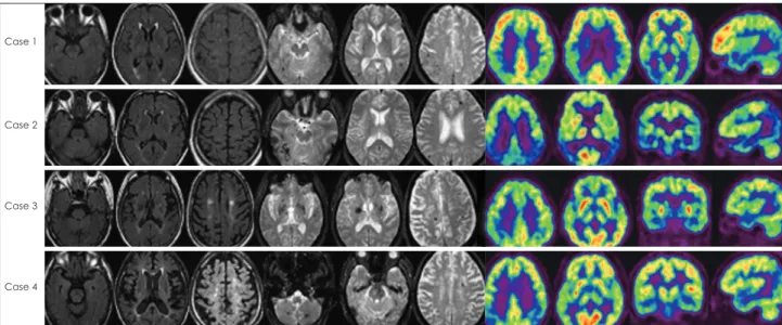 Figure 1. Axial fluid attenuated inversion recovery scan and gradient-recalled echo magnetic resonance imaging scan of the brain and positron  emission tomography of the brain