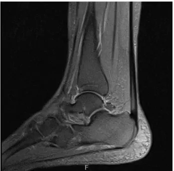 Fig.  1.  Rt.  Ankle  lateral  view  X-ray  (2014.12.5). Fig.  3.  Rt.  Ankle-MRI  T2