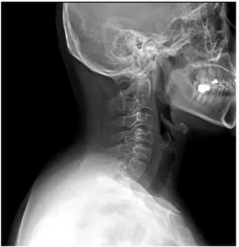Fig.  2.  C-spine  MRI sagittal  view  T2  weighted image  (14-05-16):