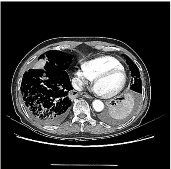 Fig.  2.  Chest  X-ray  at  May  14,  2015.  Possible  pneumonia  in  BLLs  and  both  pleural  effusion.