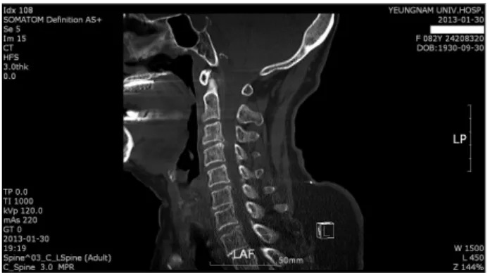 Fig.  2.  Sagittal  CT  of  case  2.  Herniated  intervertebral  discs  of  C3-4,  C5-6,  C6-7  level.