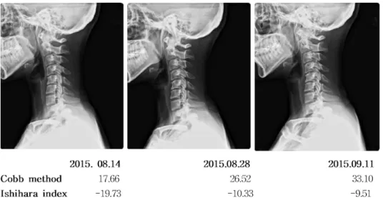 Fig.  4.  The  change  of  cervical  cur- cur-vature in C-spine lat.  view  (Case  1)