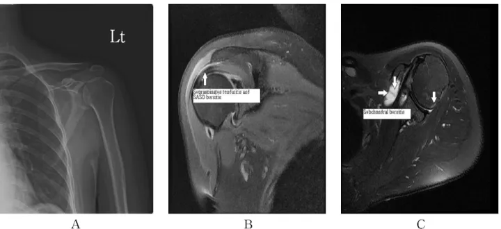 Fig.  1.  Radiological  examination  of  left  shoulder  (A:  AP  view  of  X-ray  on  2015.3.9.,  B:  coronal  view  of  MRI  on  2015.3.26.,  C:  axial  view  of  MRI  on  2015.3.26.).