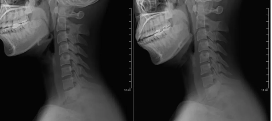 Table  IV.  The  Change  of  Case  4  after  Treatment5)  치료  경과