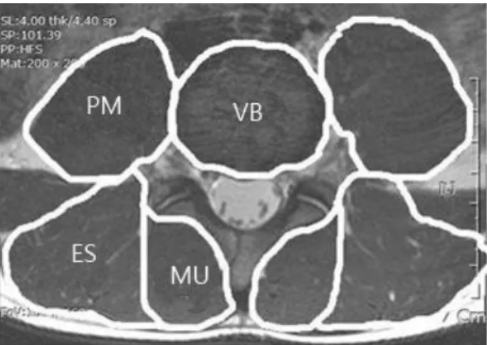 Fig.  2.  T2-weighted  image  obtained  in  an  axial  plane  of  the  center  height  of  L4-5