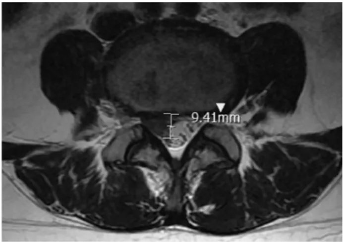 Fig.  1.  Classification  of  disc  herniation  location 8) . Fig.  3.  Disc  herniation  diameter  of  post-treatment.