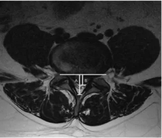Fig.  2.  Spinal  canal  occupying  ratio=B/A×100  (%).Matsubara18),  황19)   등의  방법을  차용하여  가장  두드러지게 탈출된  추간판의  base부터  종축까지의  길이와  척추관의  종축  길이의  비,  즉  척추관  점유비을  INFINITT  PACS  G3 (ver3.0.10.2,  INFINITT,  서울,  한국)  프로그램을  이용하여 서로  다른  2인이  2회  측정한  후