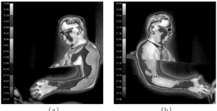 Fig.  1.  Thermograpy  of  hemiplegic  patient.  (a)  Hemiplegic  side;  average  temperature  was  32.05 o C