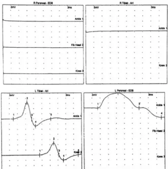 Table  Ⅱ.  Neuropathy  Pain  Scale  (NPS)