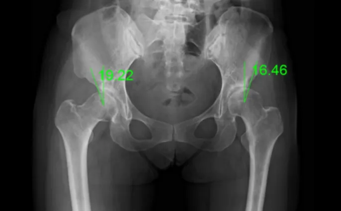 Fig.  1.  Anteroposterior  view  of  pelvis  X-ray,  December  6,  2019.
