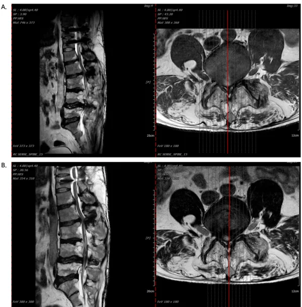 Fig.  1.  (A)  L-spine  MRI  (August  3,  2017),  (B)  L-spine  MRI  with  CTL  (January  21,  2018)