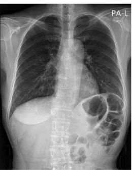 Fig.  2.  Chest  PA  (January  28,  2020).