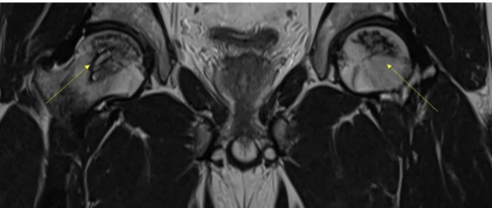 Fig.  1.  Magnetic  resonance  imaging  hip  joint  -  coronal  view  (September  20,  2019).