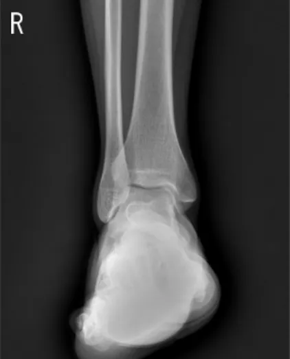 Fig.  4.  MRI  of  Patient's  right  ankle  (Axial  view,  case1-2015-  10-29). Thinning of Anterior talofibular ligament Increased signal intensity,  continuity  disruption  of  ATFL.